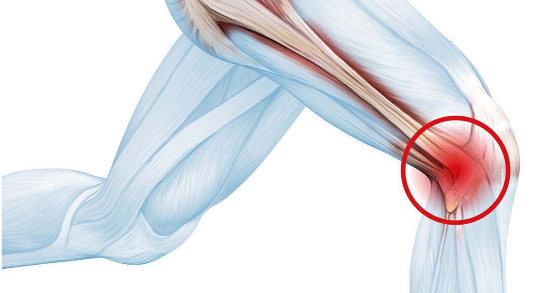 IMPACT Running Issue_Web_Banners20 Running and IT Band Pain