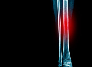 The High-Impact Injury